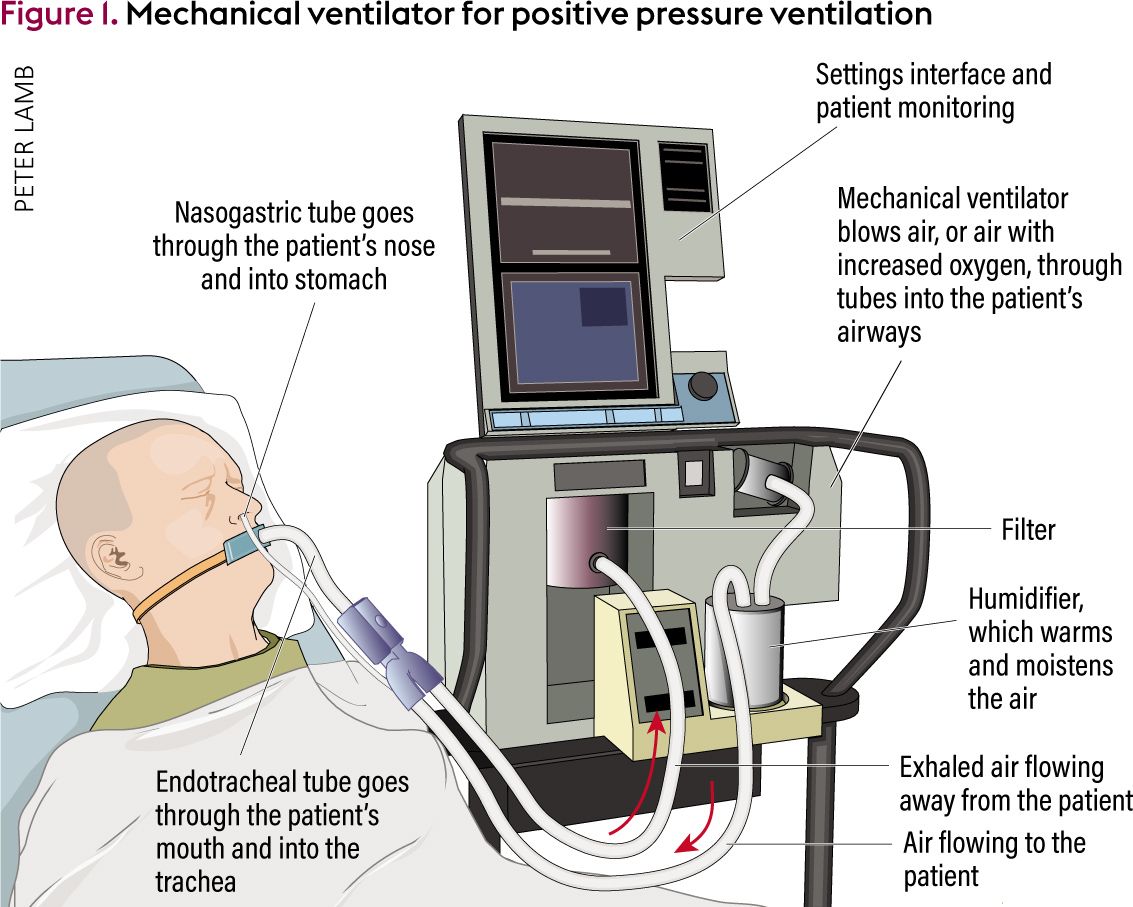 ventilator patient trach