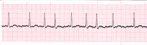 atrial-fibrillation