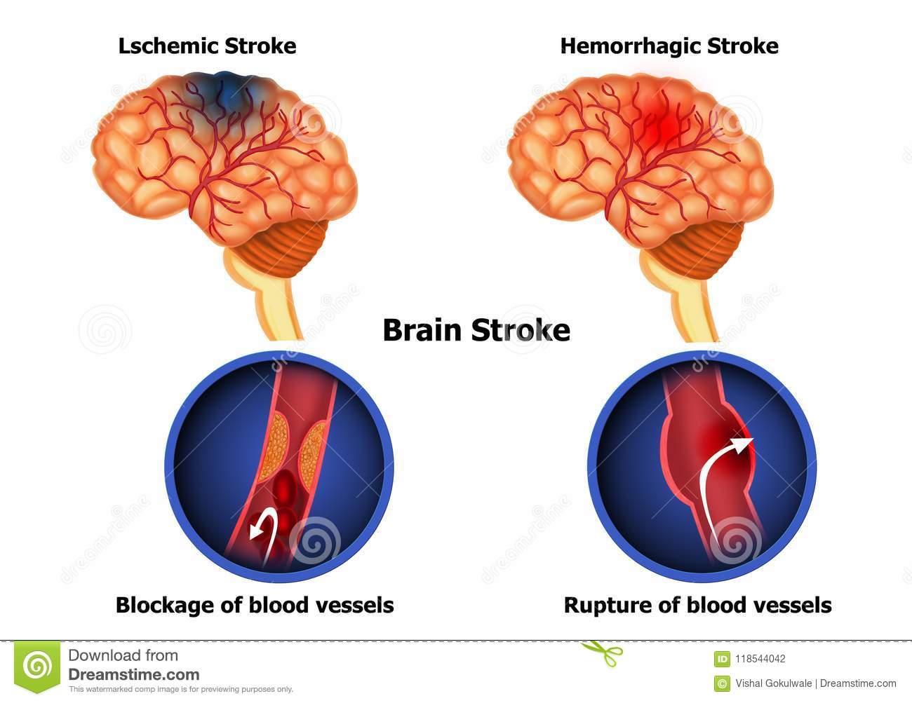 brain hemorrhage diagram
